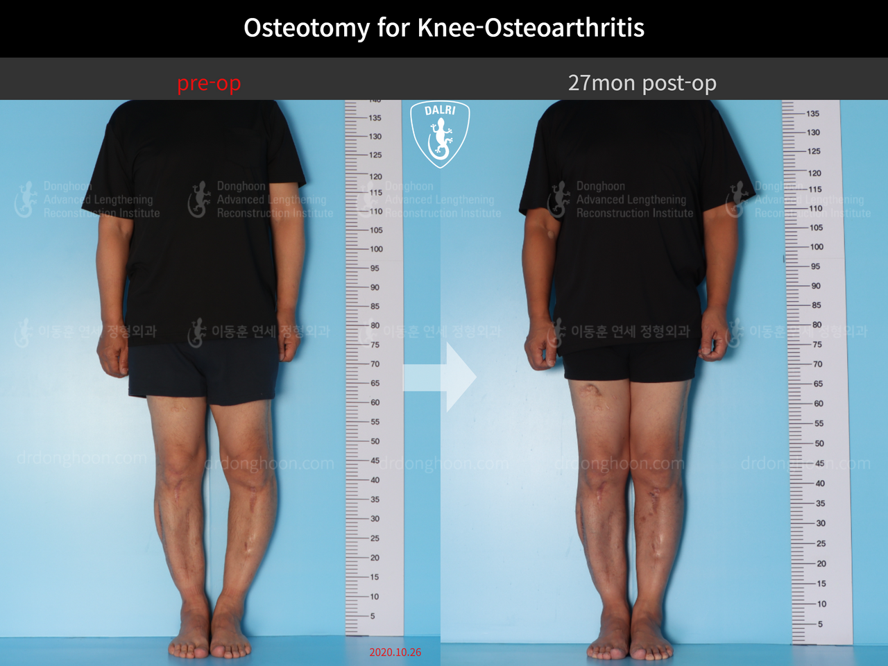 Before and after osteotomy for knee osteoarthritis, case 12535590, image 3, Dr. Donghoon institute (DALRI)