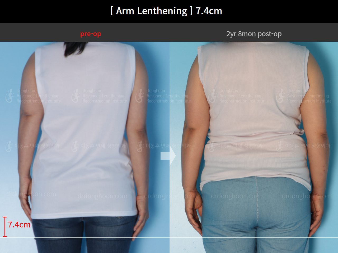 Before and after arm lengthening, case 15460631, image 2, Dr. Donghoon institute (DALRI)