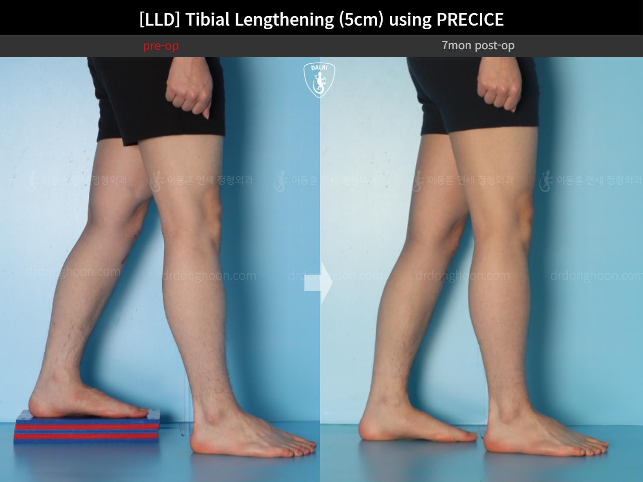 Before and after adult lld, case 18471613, image 8, Dr. Donghoon institute (DALRI)