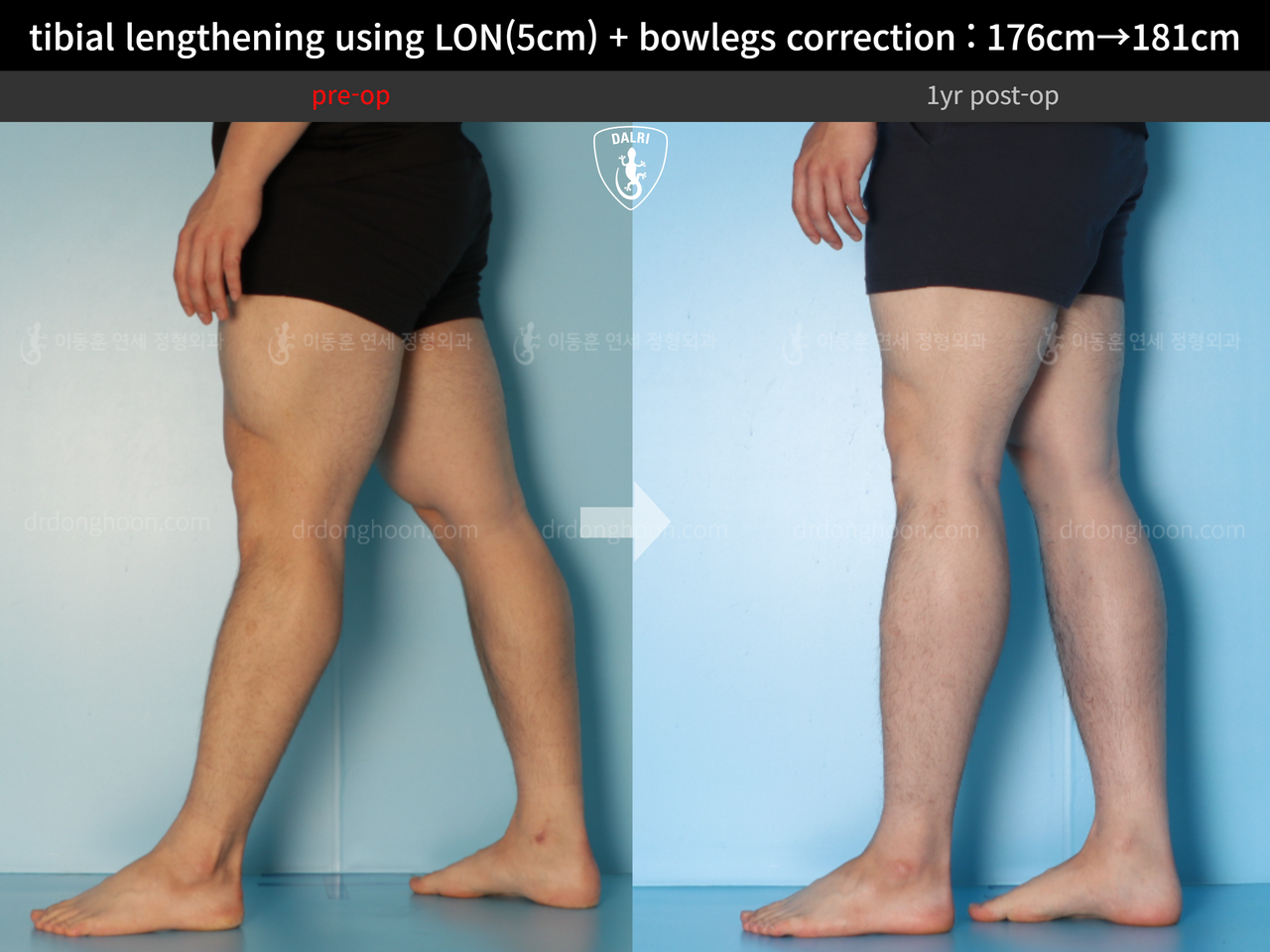 Before and after cll + deformity correction, case 13410849, image 9, Dr. Donghoon institute (DALRI)