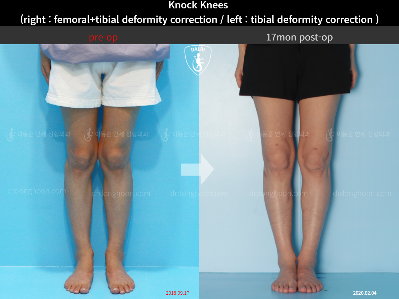 Before and after adult knock knees, case 4640565, image 3, Dr. Donghoon institute (DALRI)