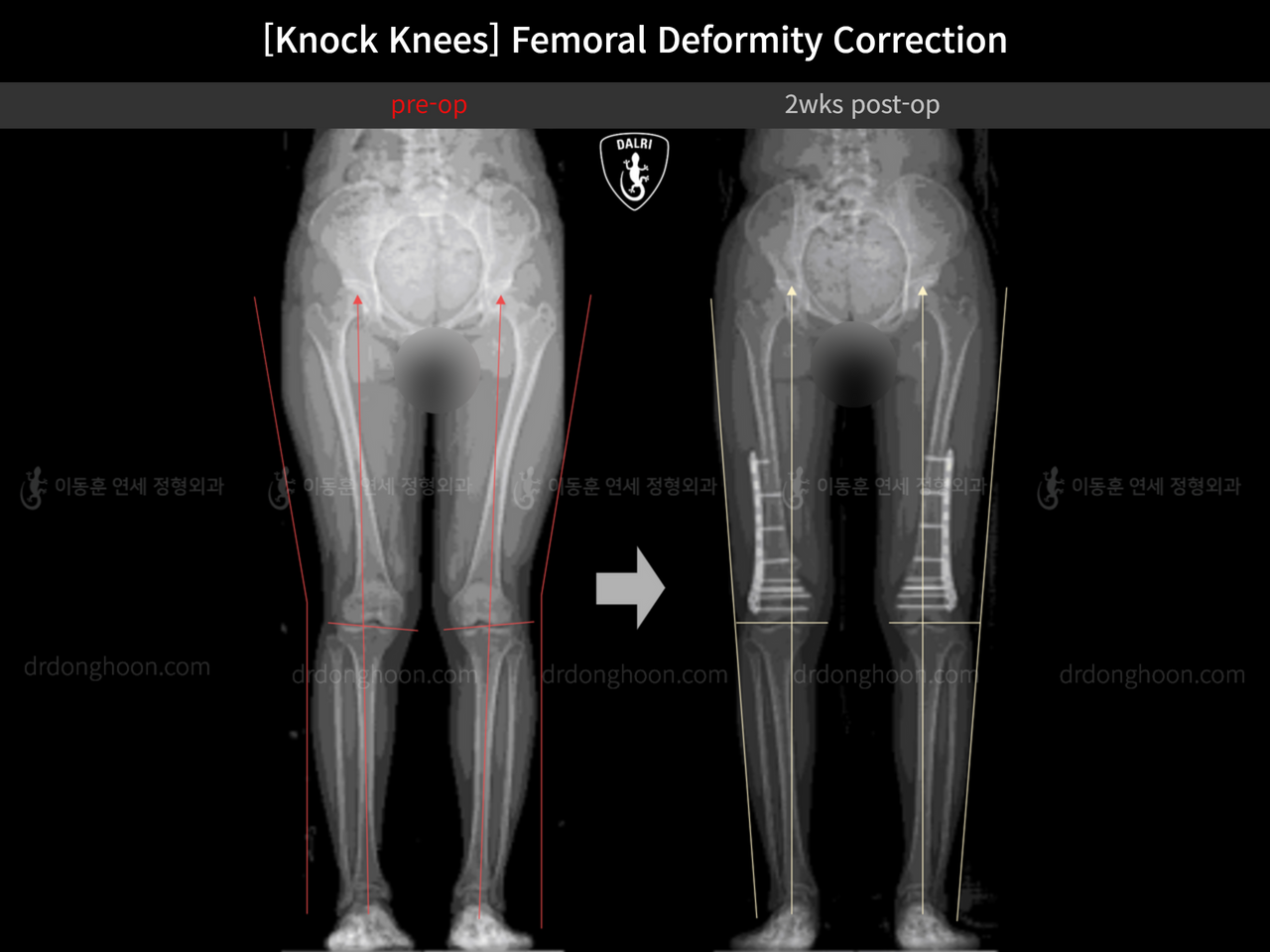Before and after adult knock knees, case 14343877, image 8, Dr. Donghoon institute (DALRI)