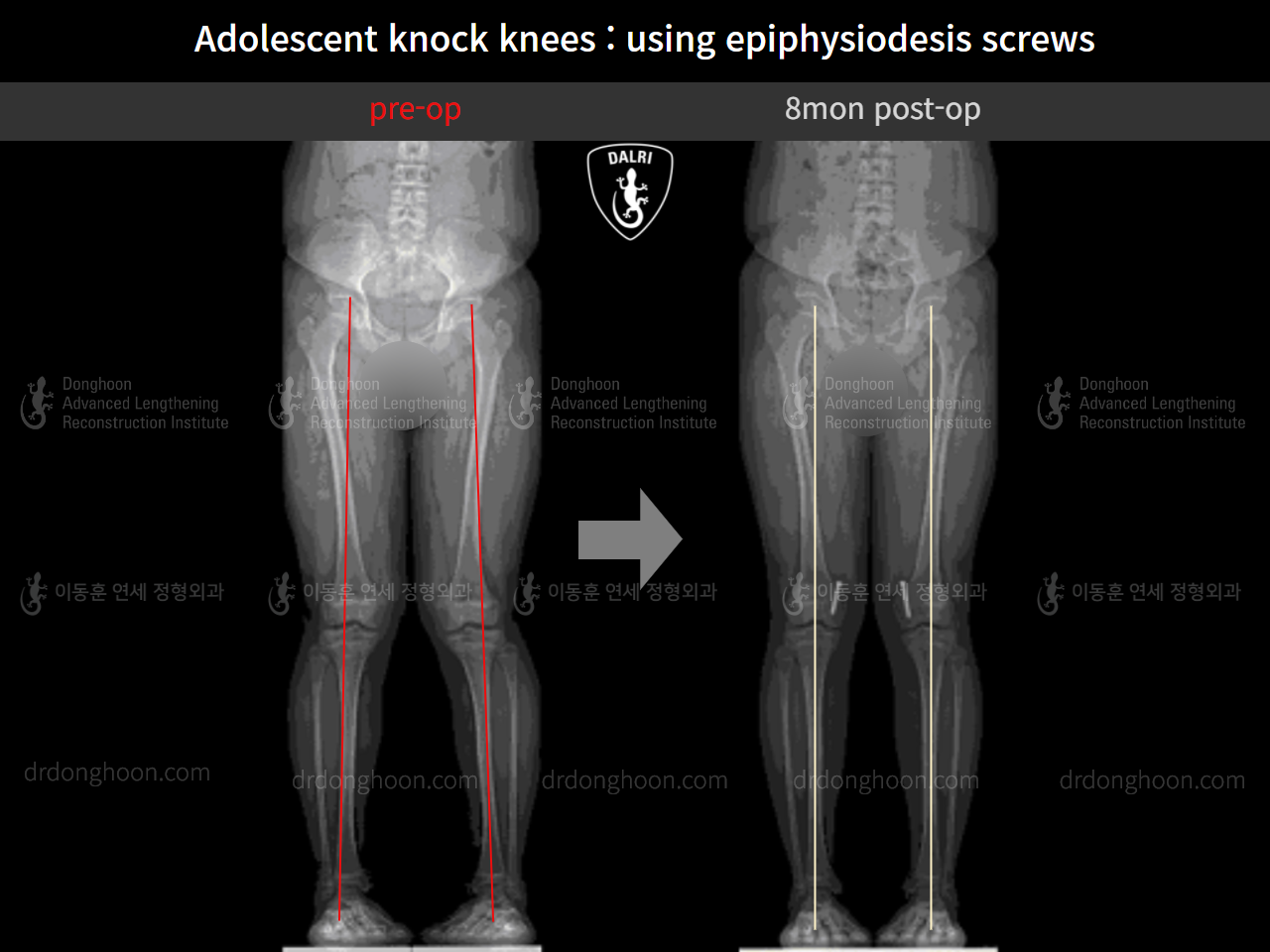 Before and after paediatric & adolescent knock knees, case 9743785, image 7, Dr. Donghoon institute (DALRI)