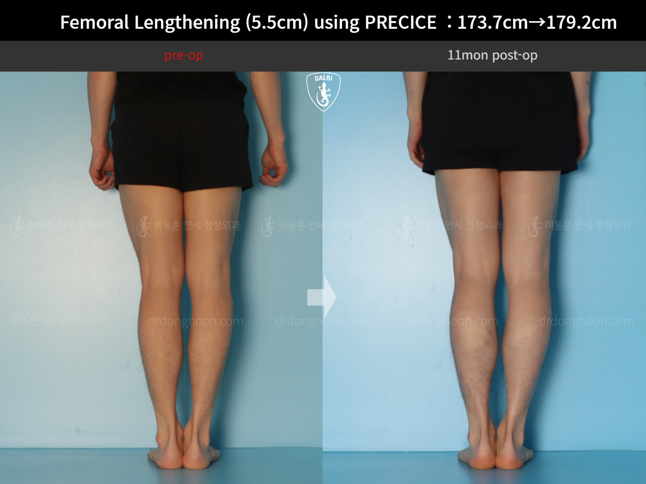 Before and after cll precice, case 18140453, image 9, Dr. Donghoon institute (DALRI)