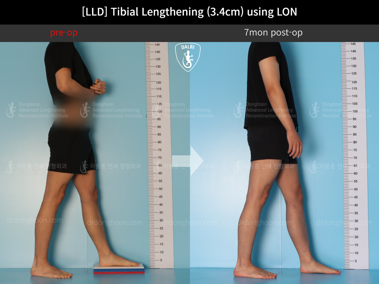Before and after adult lld, case 12529689, image 3, Dr. Donghoon institute (DALRI)