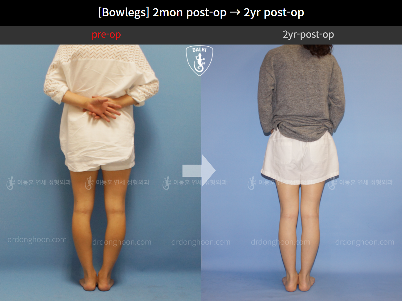 Before and after adult bowlegs, case 4311373, image 4, Dr. Donghoon institute (DALRI)