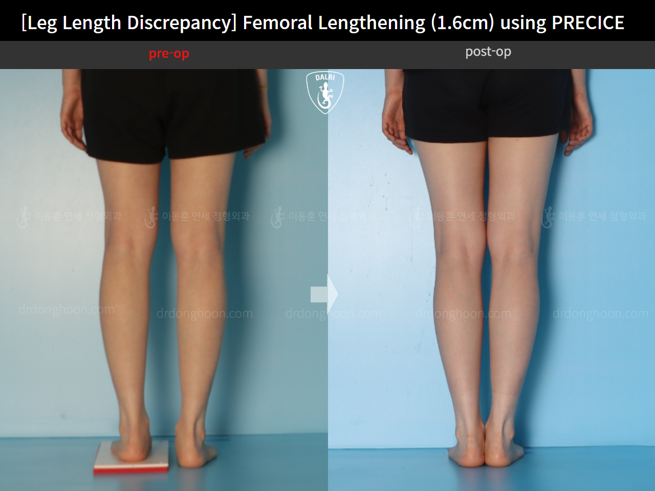 Before and after adult lld, case 15705968, image 8, Dr. Donghoon institute (DALRI)