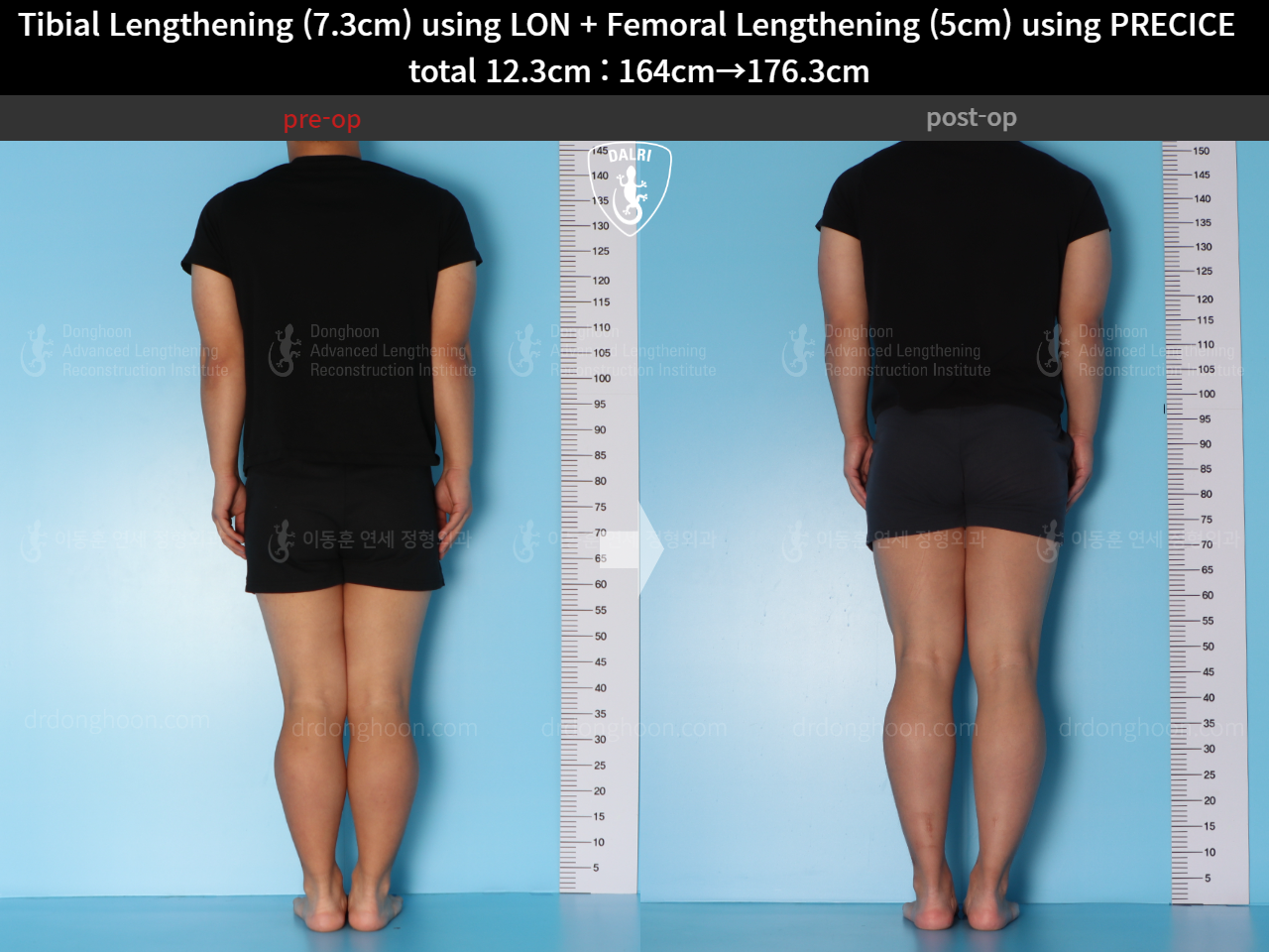 Before and after cll precice, case 15592732, image 2, Dr. Donghoon institute (DALRI)