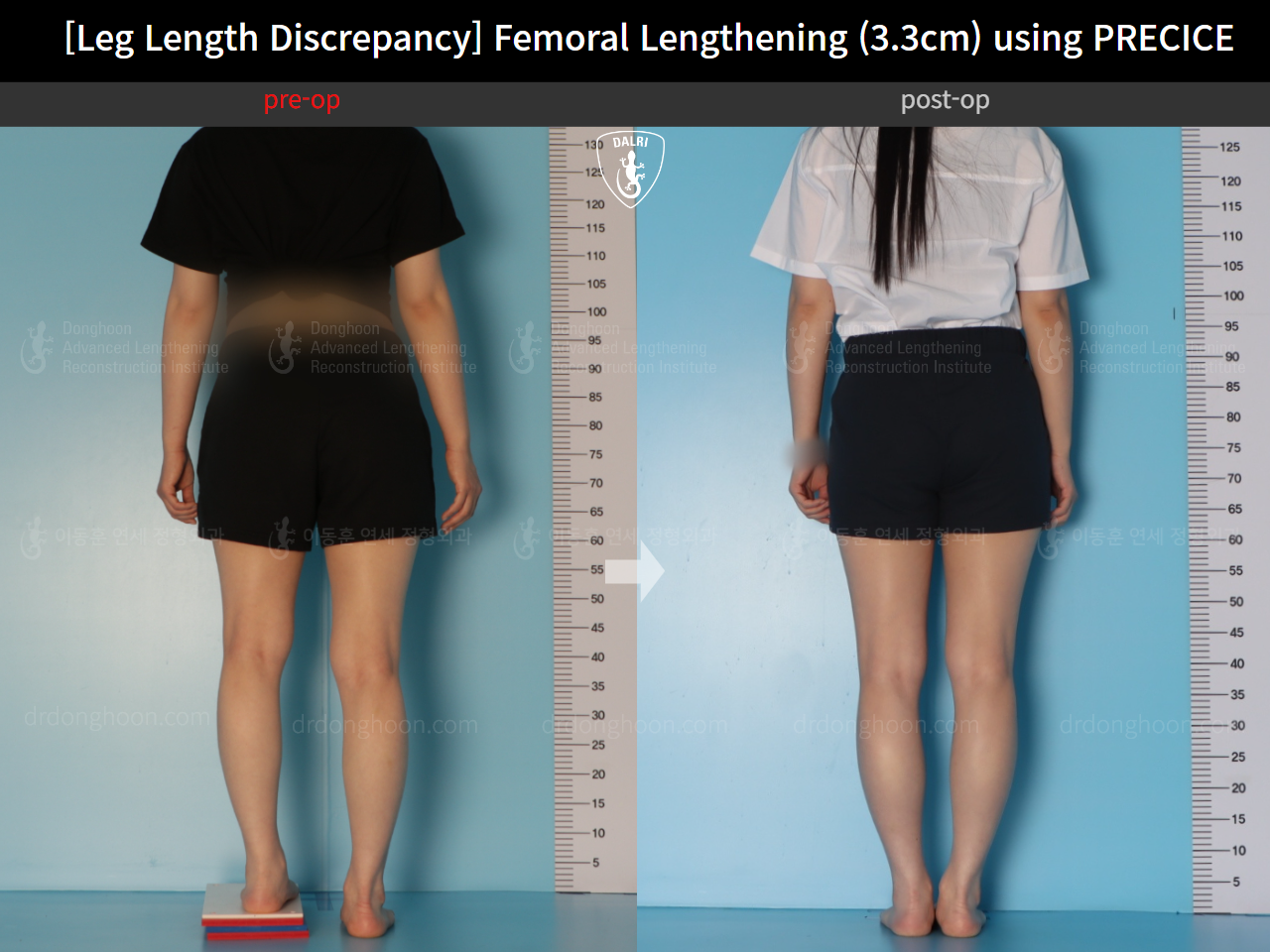 Before and after adult lld, case 22355841, image 2, Dr. Donghoon institute (DALRI)