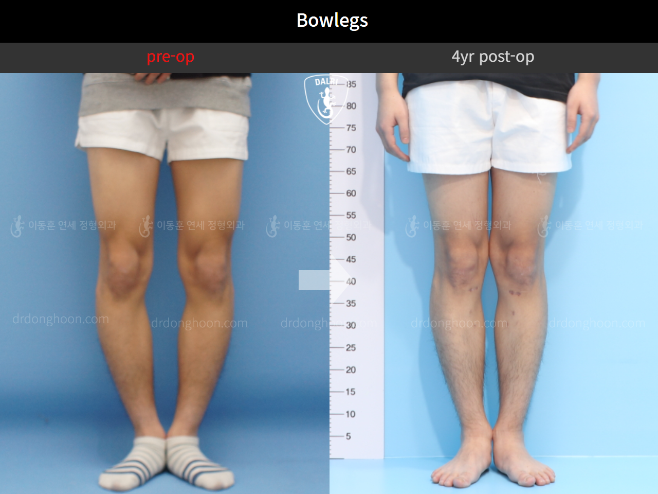 Before and after adult bowlegs, case 4311360, image 6, Dr. Donghoon institute (DALRI)