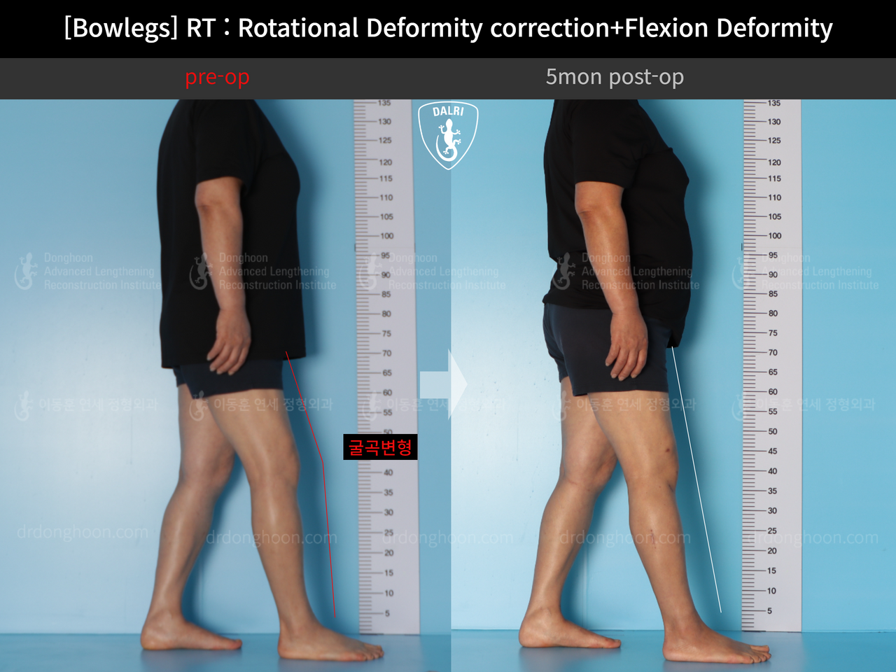 Before and after adult bowlegs, case 13668670, image 3, Dr. Donghoon institute (DALRI)