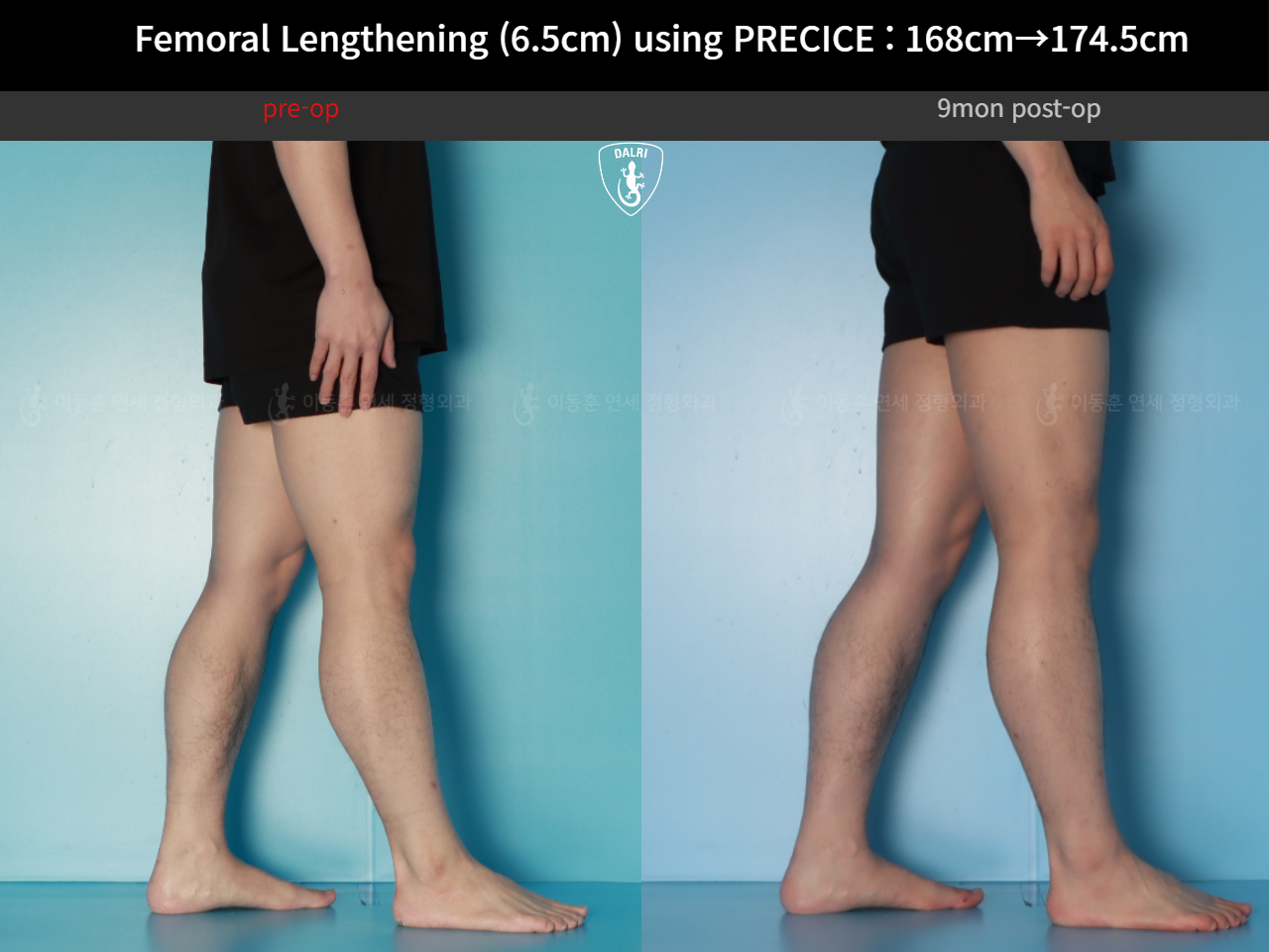 Before and after cll precice, case 123911358, image 10, Dr. Donghoon institute (DALRI)