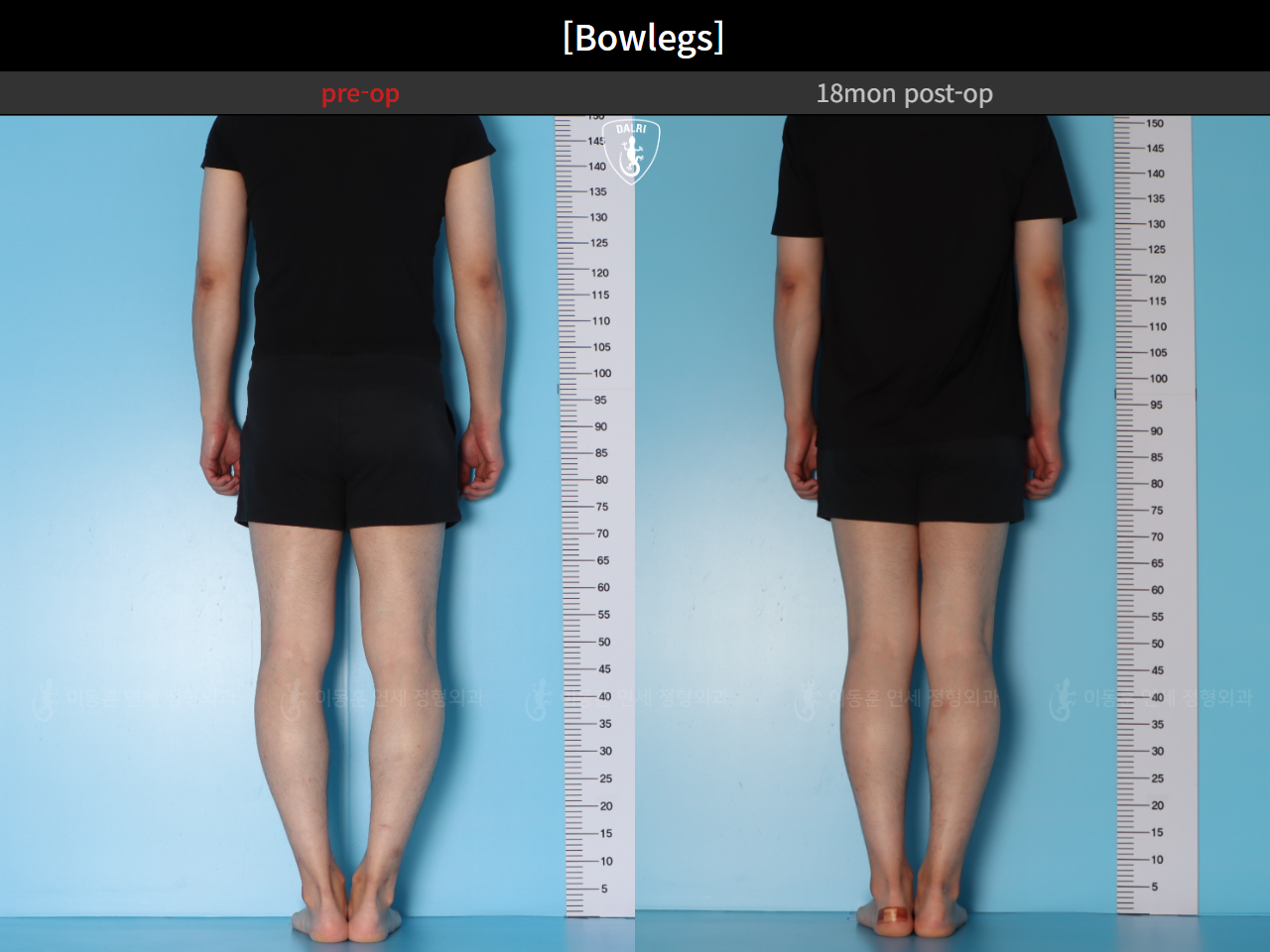 Before and after adult bowlegs, case 94769040, image 6, Dr. Donghoon institute (DALRI)
