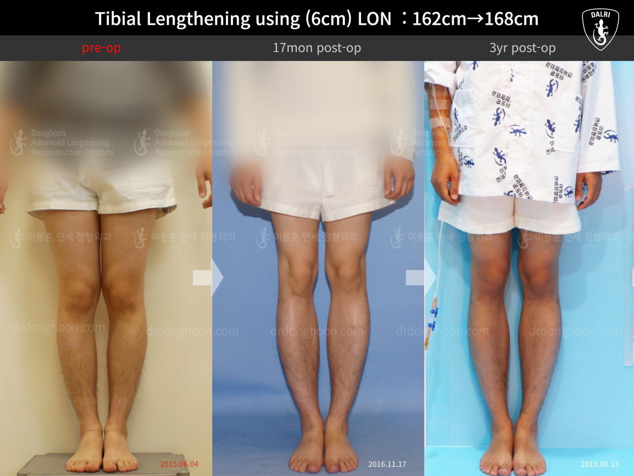 ภาพก่อน-หลัง ยืดขาเทคนิค LON เคสที่ 13552941 ภาพที่ 1 จากโรงพยาบาลศัลยกรรมกระดูกลีดงฮุน (DALRI)