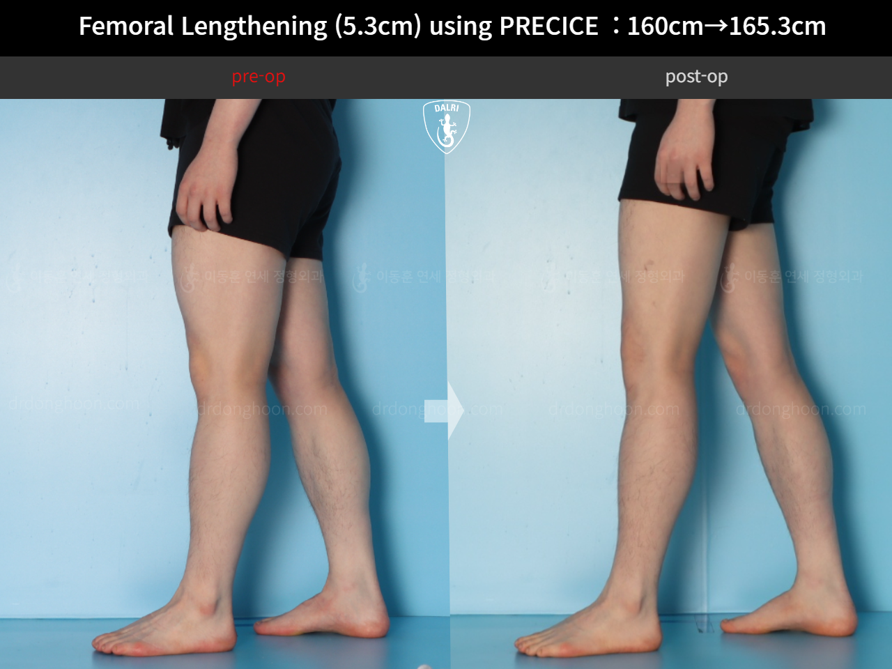 Before and after cll precice, case 18250566, image 10, Dr. Donghoon institute (DALRI)