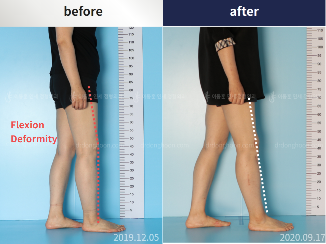 Before and after osteotomy for knee osteoarthritis, case 5203391, image 2, Dr. Donghoon institute (DALRI)