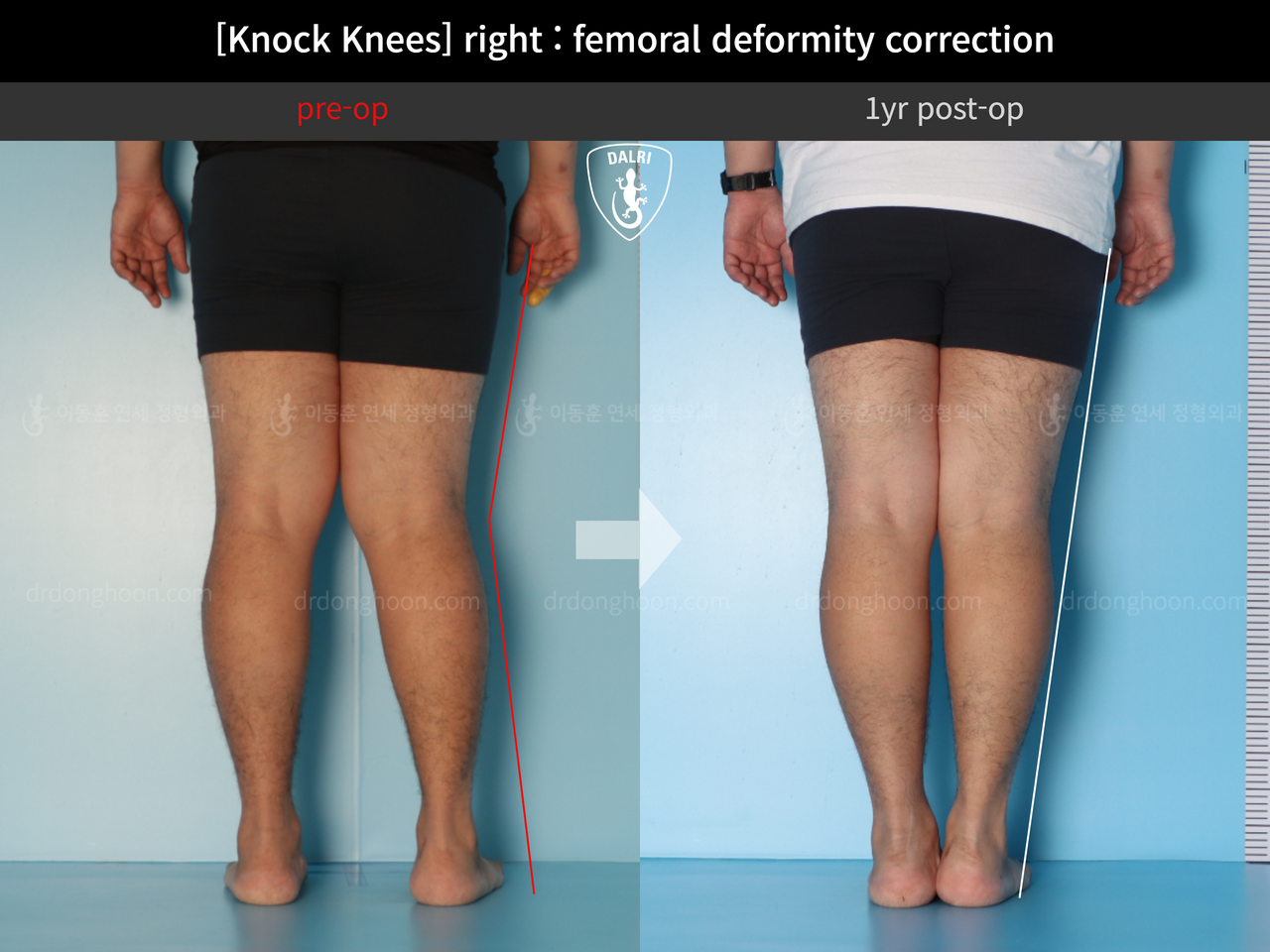 Before and after adult knock knees, case 13582115, image 4, Dr. Donghoon institute (DALRI)