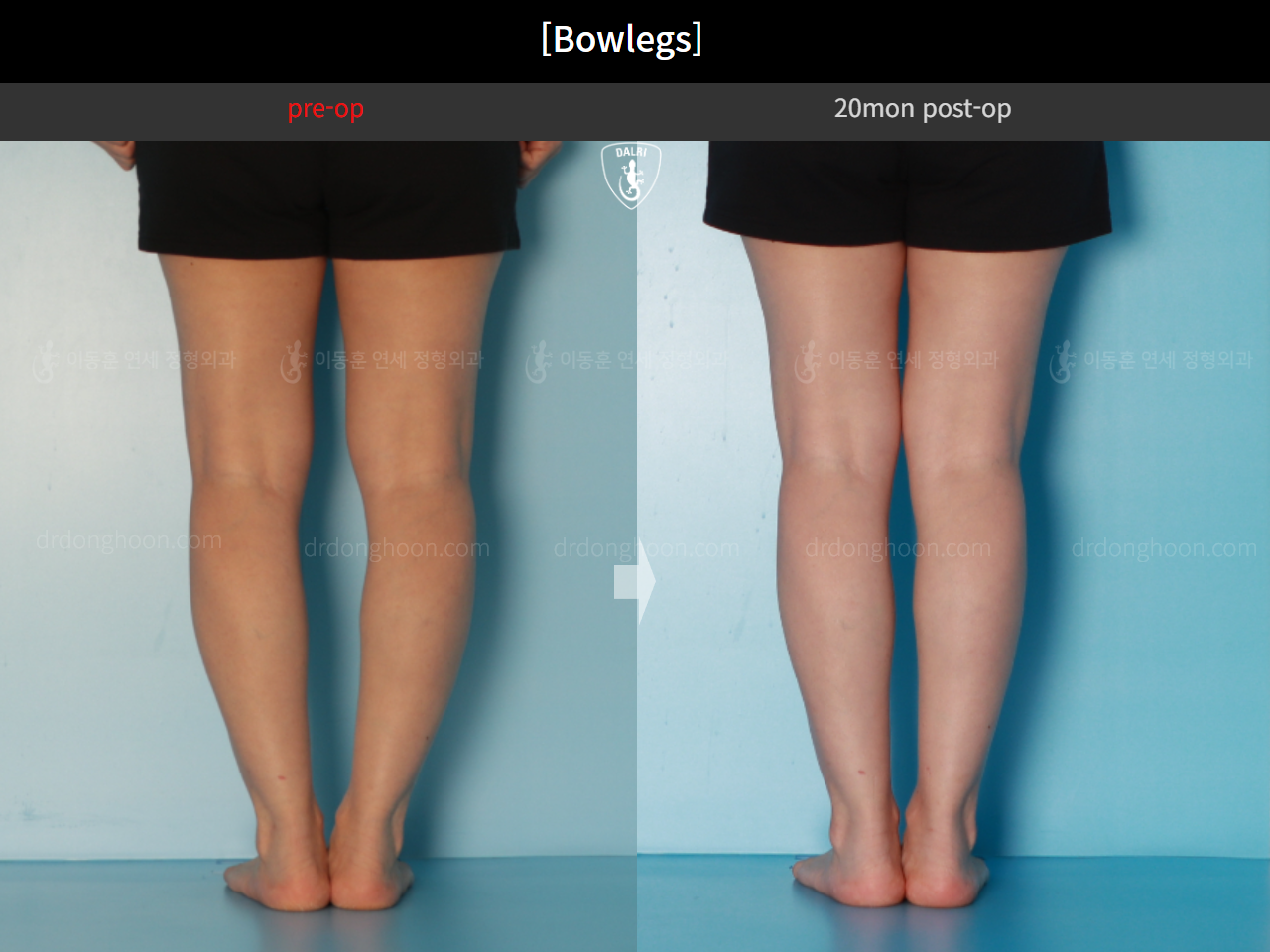 Before and after adult bowlegs, case 16724630, image 7, Dr. Donghoon institute (DALRI)