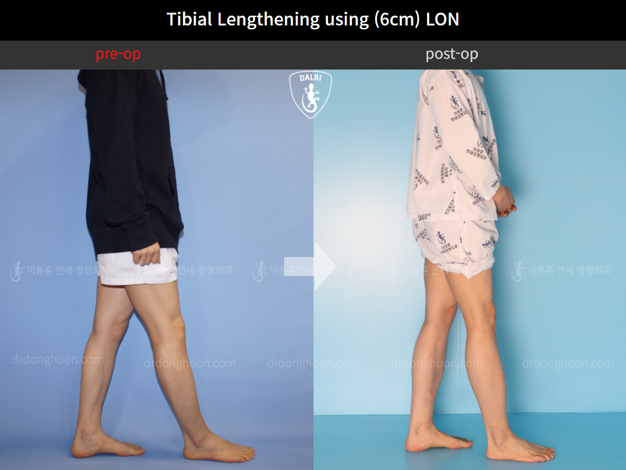 Before and after cll lon, case 4577694, image 3, Dr. Donghoon institute (DALRI)
