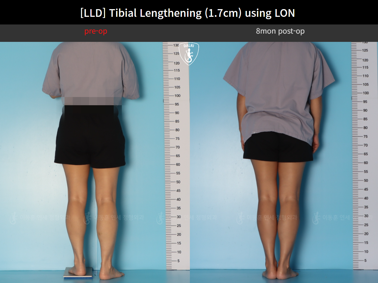 Before and after adult lld, case 126715948, image 2, Dr. Donghoon institute (DALRI)