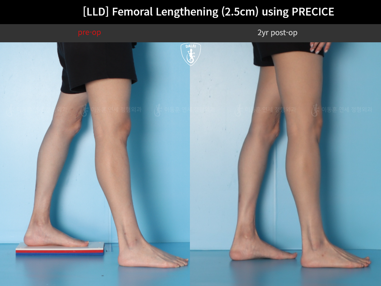 Before and after adult lld, case 89087135, image 8, Dr. Donghoon institute (DALRI)