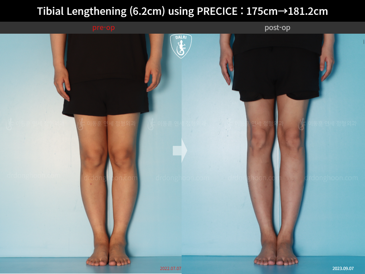 Before and after cll precice, case 16277428, image 9, Dr. Donghoon institute (DALRI)