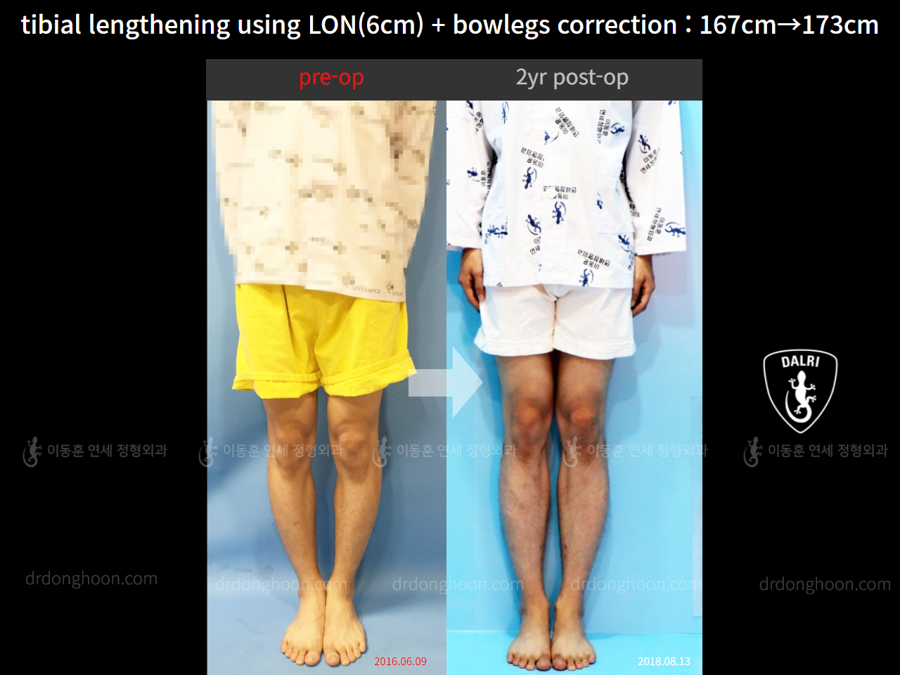 Before and after cll + deformity correction, case 4323147, image 1, Dr. Donghoon institute (DALRI)