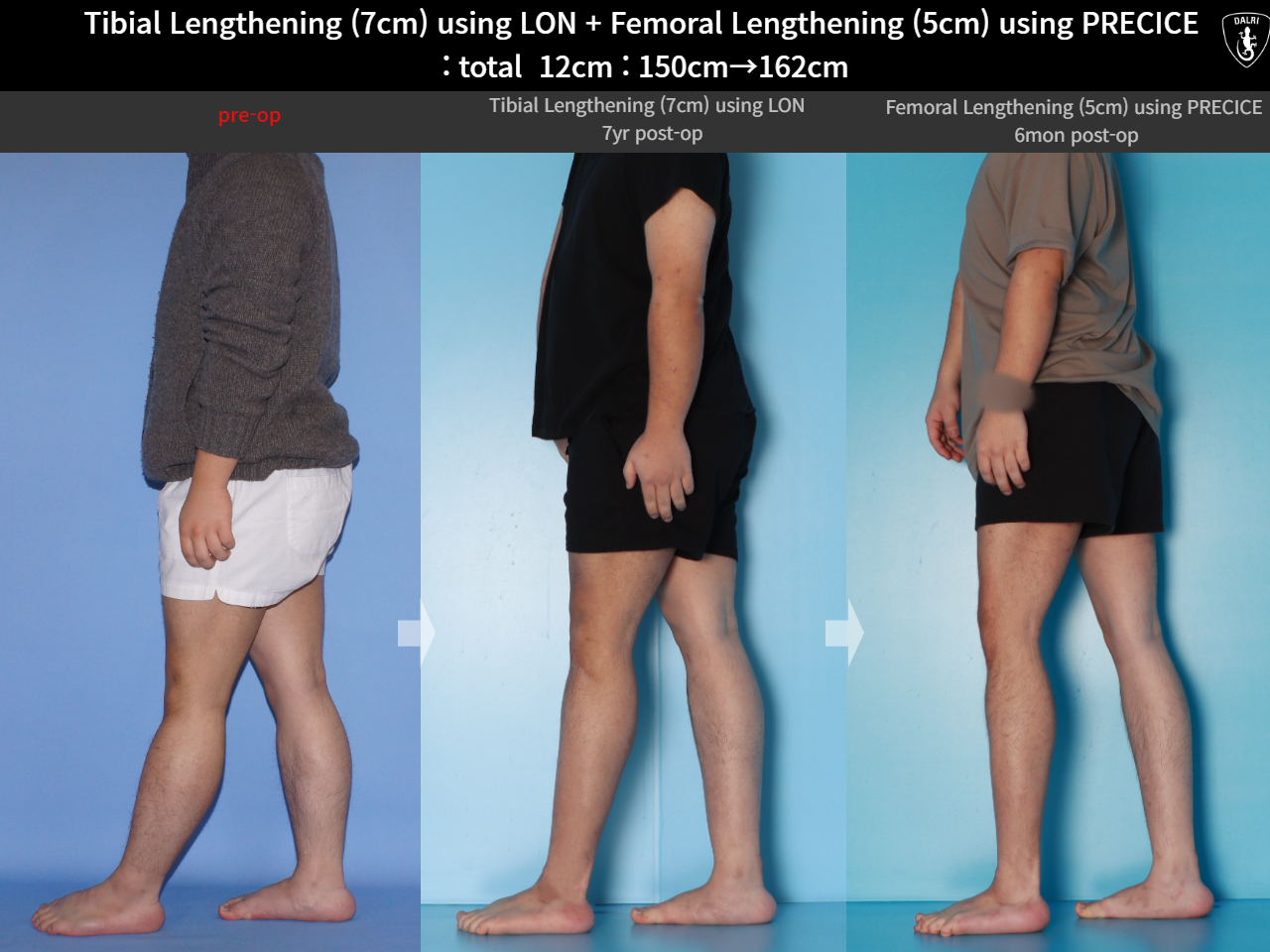 Before and after cll precice, case 16146445, image 4, Dr. Donghoon institute (DALRI)