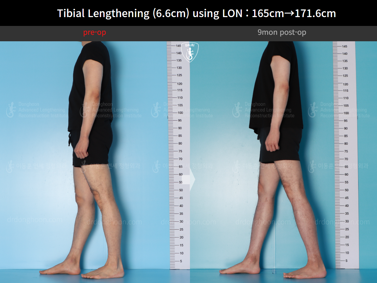 Before and after cll lon, case 16780660, image 6, Dr. Donghoon institute (DALRI)