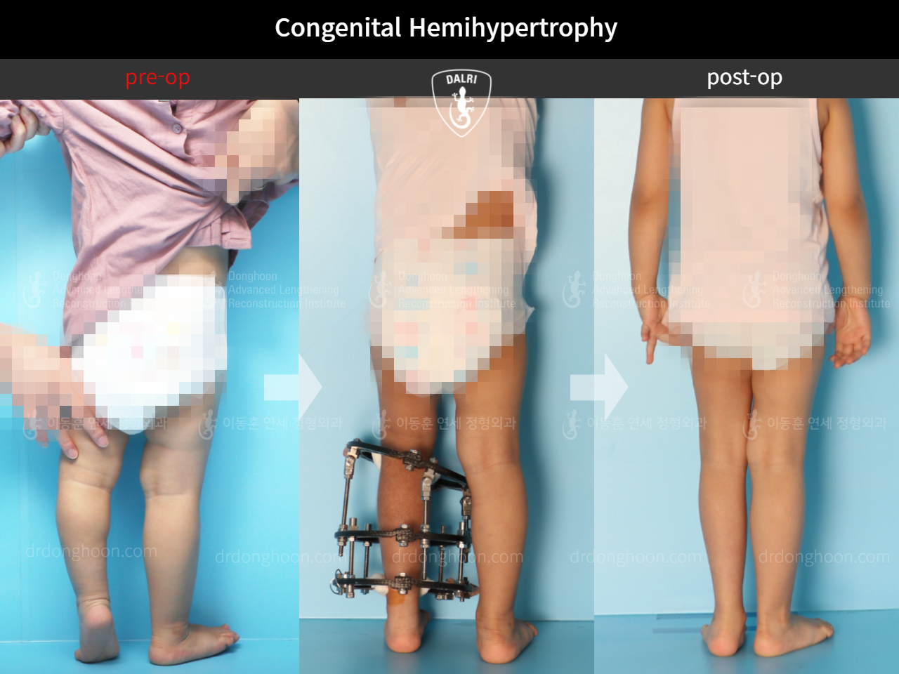 Before and after paediatric congenital condition, case 9478998, image 2, Dr. Donghoon institute (DALRI)
