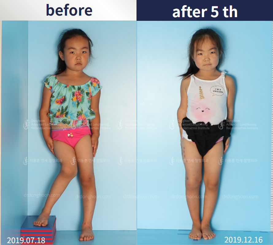 Before and after paediatric congenital condition, case 4304803, image 3, Dr. Donghoon institute (DALRI)