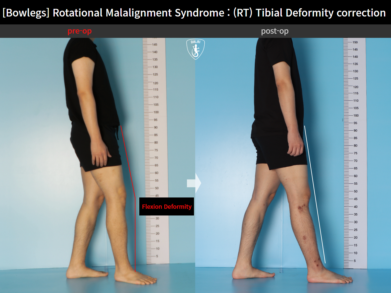 Before and after adult bowlegs, case 16482195, image 3, Dr. Donghoon institute (DALRI)