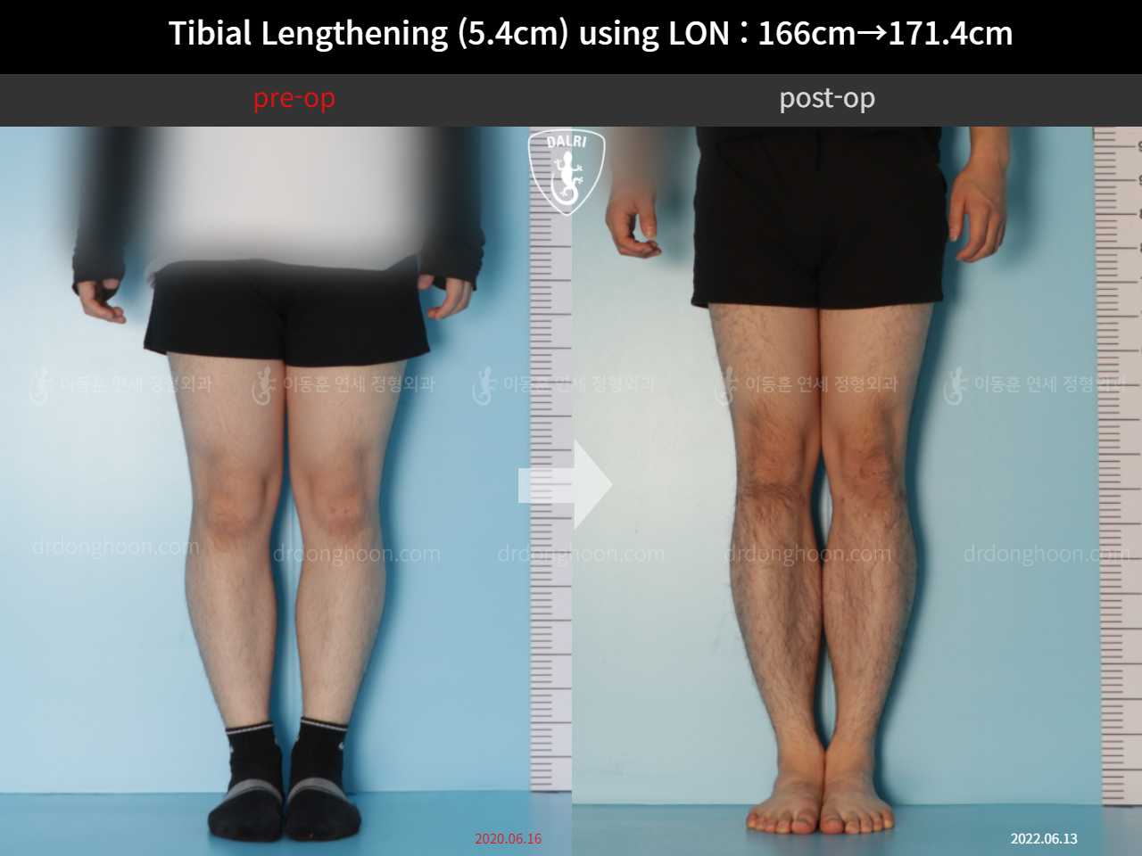 Before and after cll lon, case 11831572, image 5, Dr. Donghoon institute (DALRI)