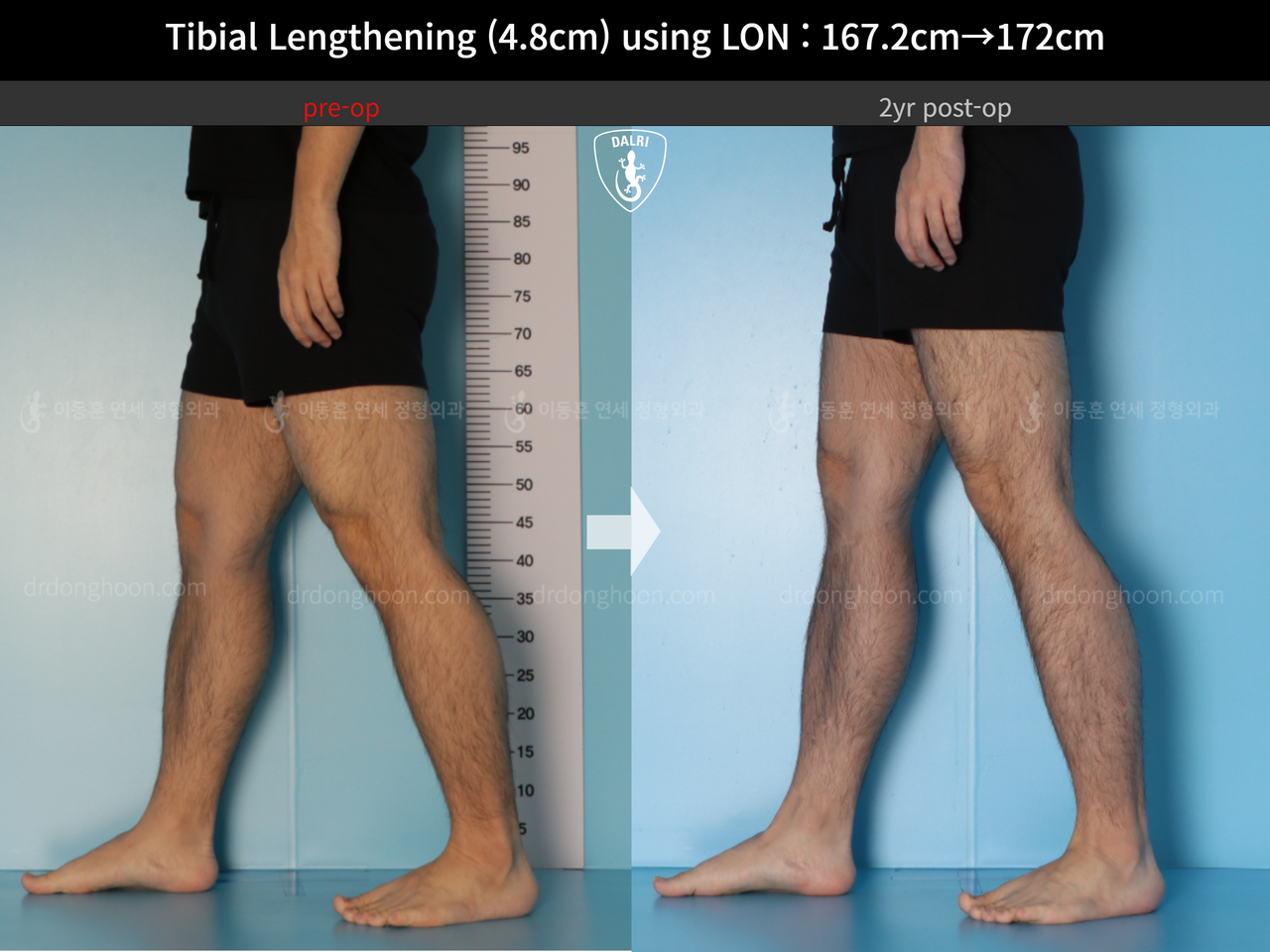 Before and after cll lon, case 14418932, image 8, Dr. Donghoon institute (DALRI)