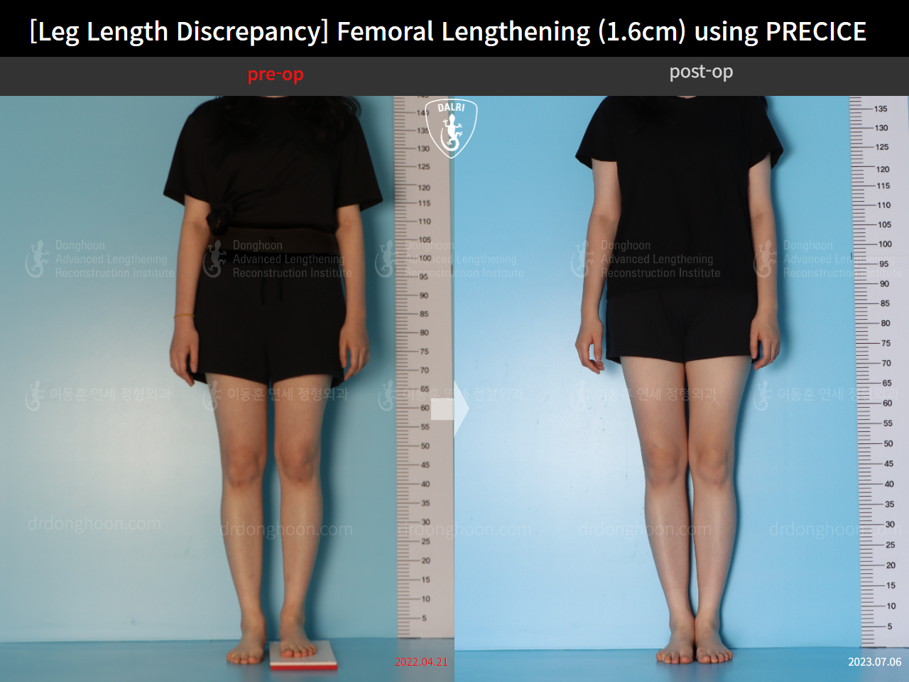 Before and after adult lld, case 15705968, image 1, Dr. Donghoon institute (DALRI)
