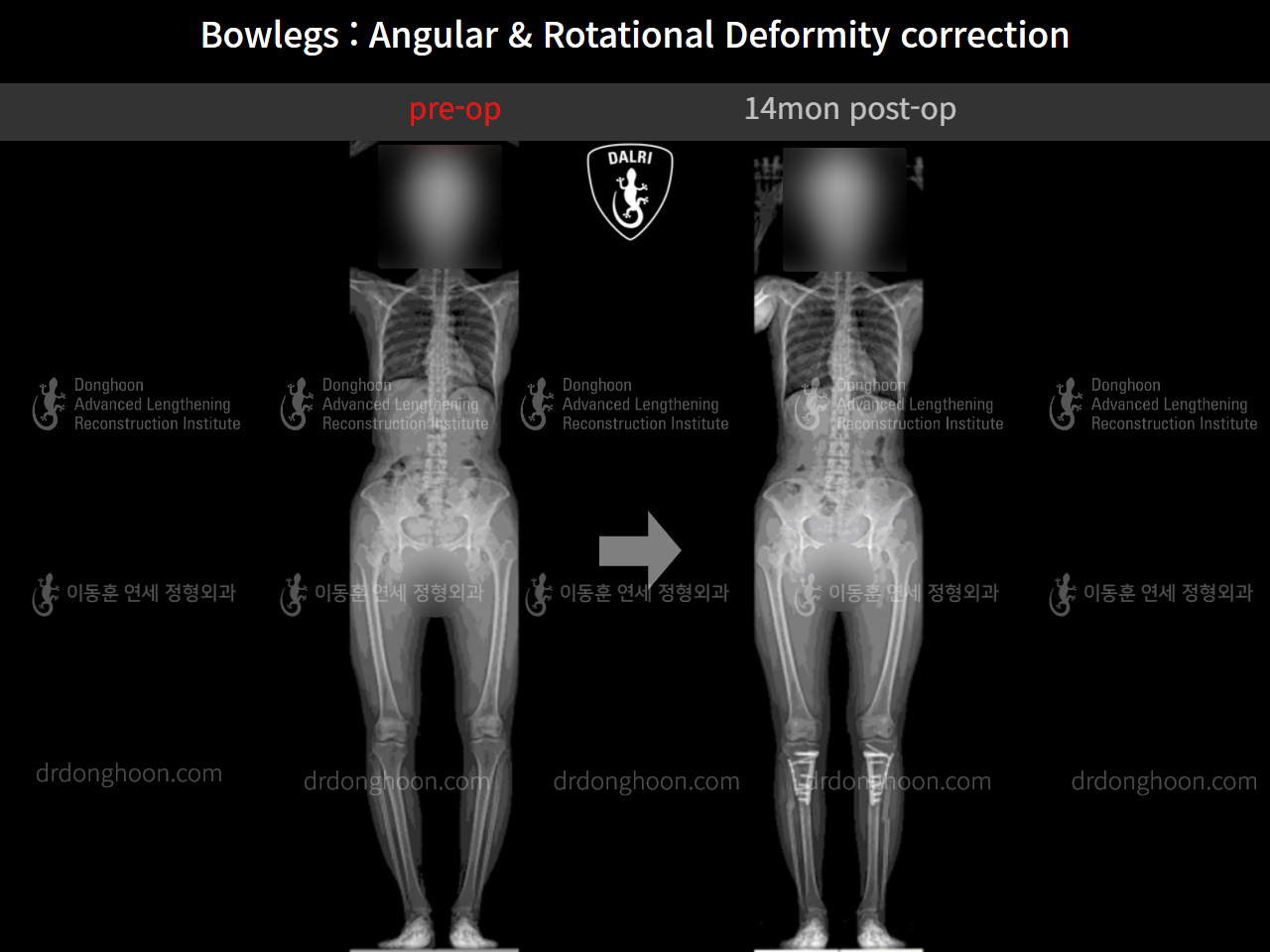 Before and after adult bowlegs, case 9557826, image 6, Dr. Donghoon institute (DALRI)