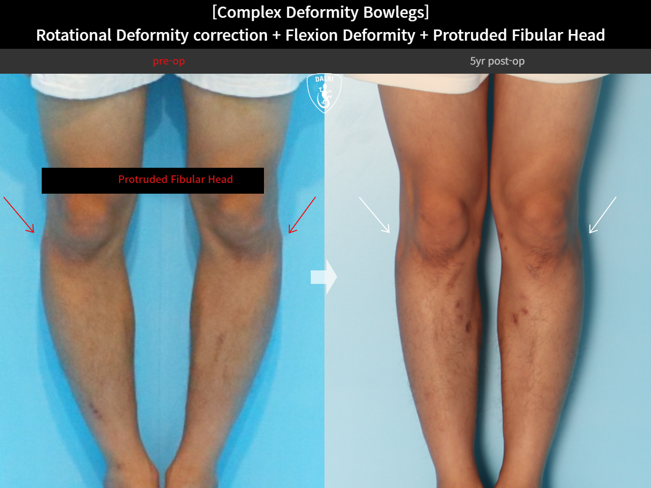 Before and after complex deformity, case 15944755, image 9, Dr. Donghoon institute (DALRI)