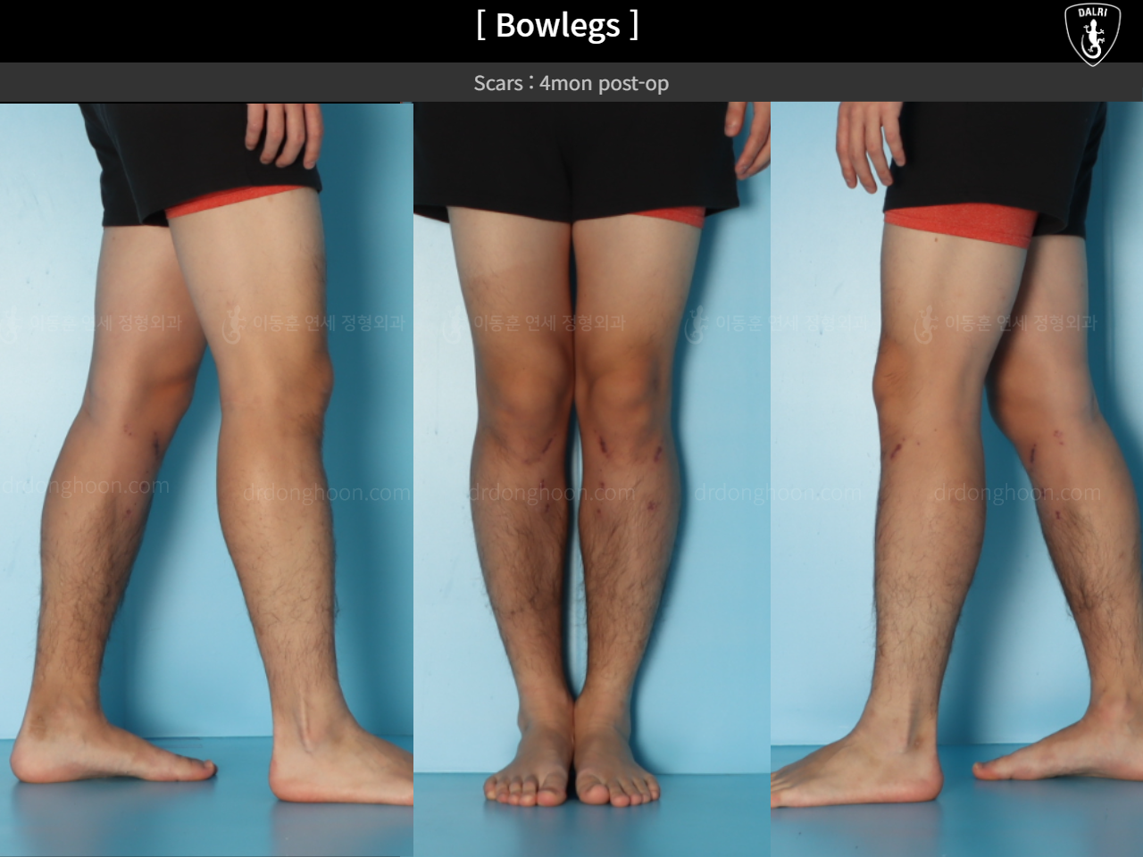 Before and after adult bowlegs, case 18479637, image 11, Dr. Donghoon institute (DALRI)