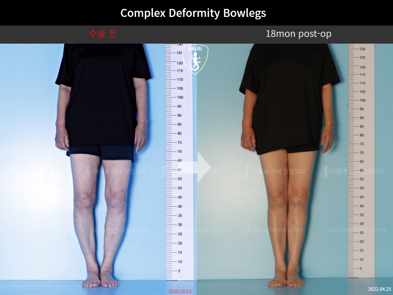 Before and after adult bowlegs, case 11337461, image 2, Dr. Donghoon institute (DALRI)