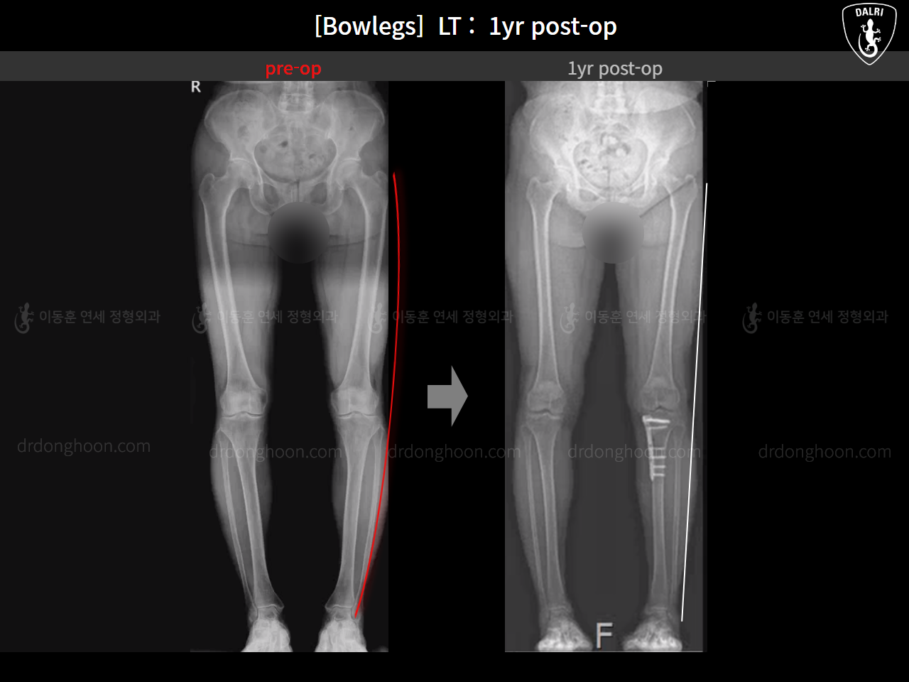Before and after adult bowlegs, case 15172734, image 12, Dr. Donghoon institute (DALRI)