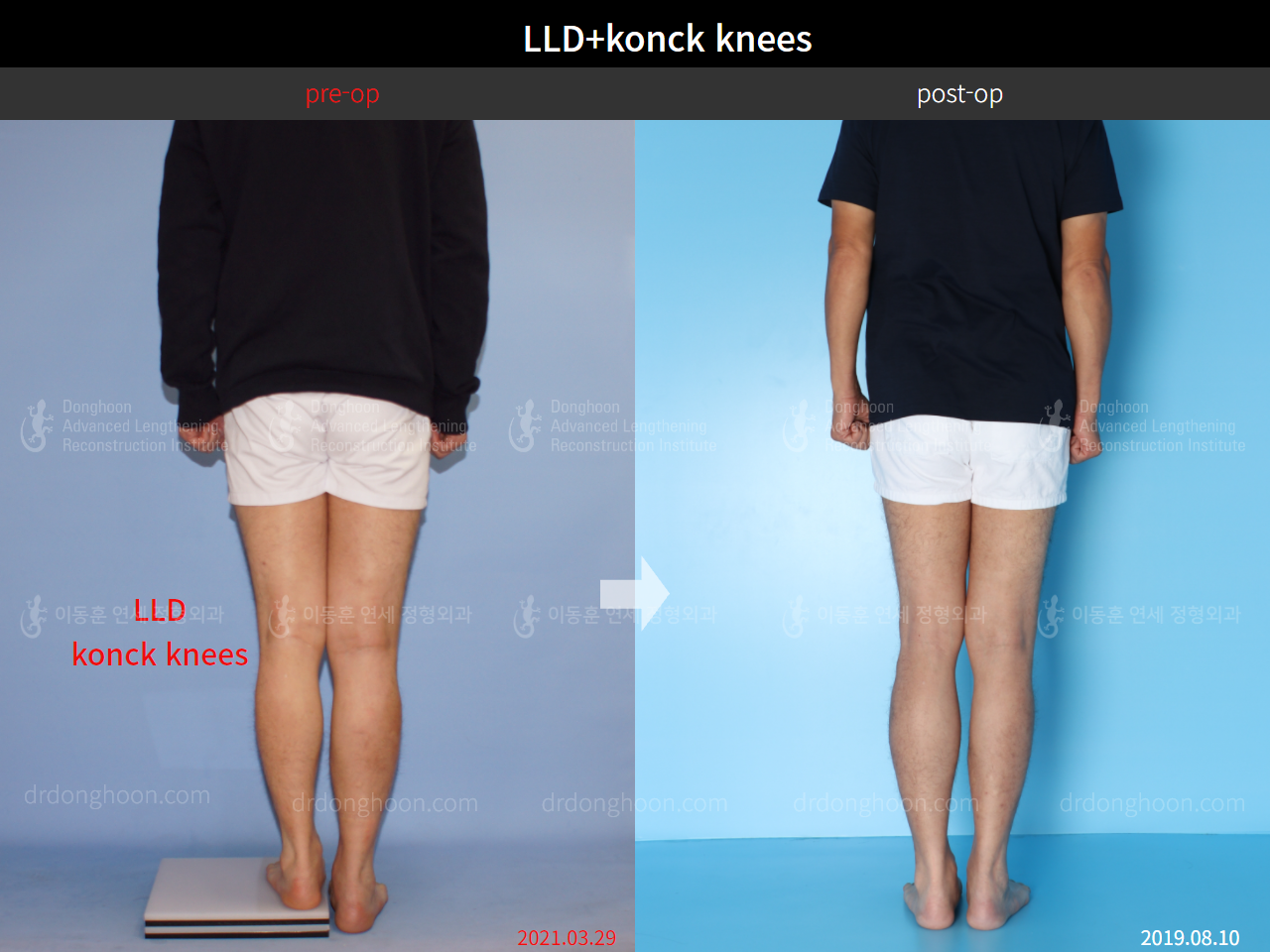 Before and after complex deformity, case 8815392, image 4, Dr. Donghoon institute (DALRI)