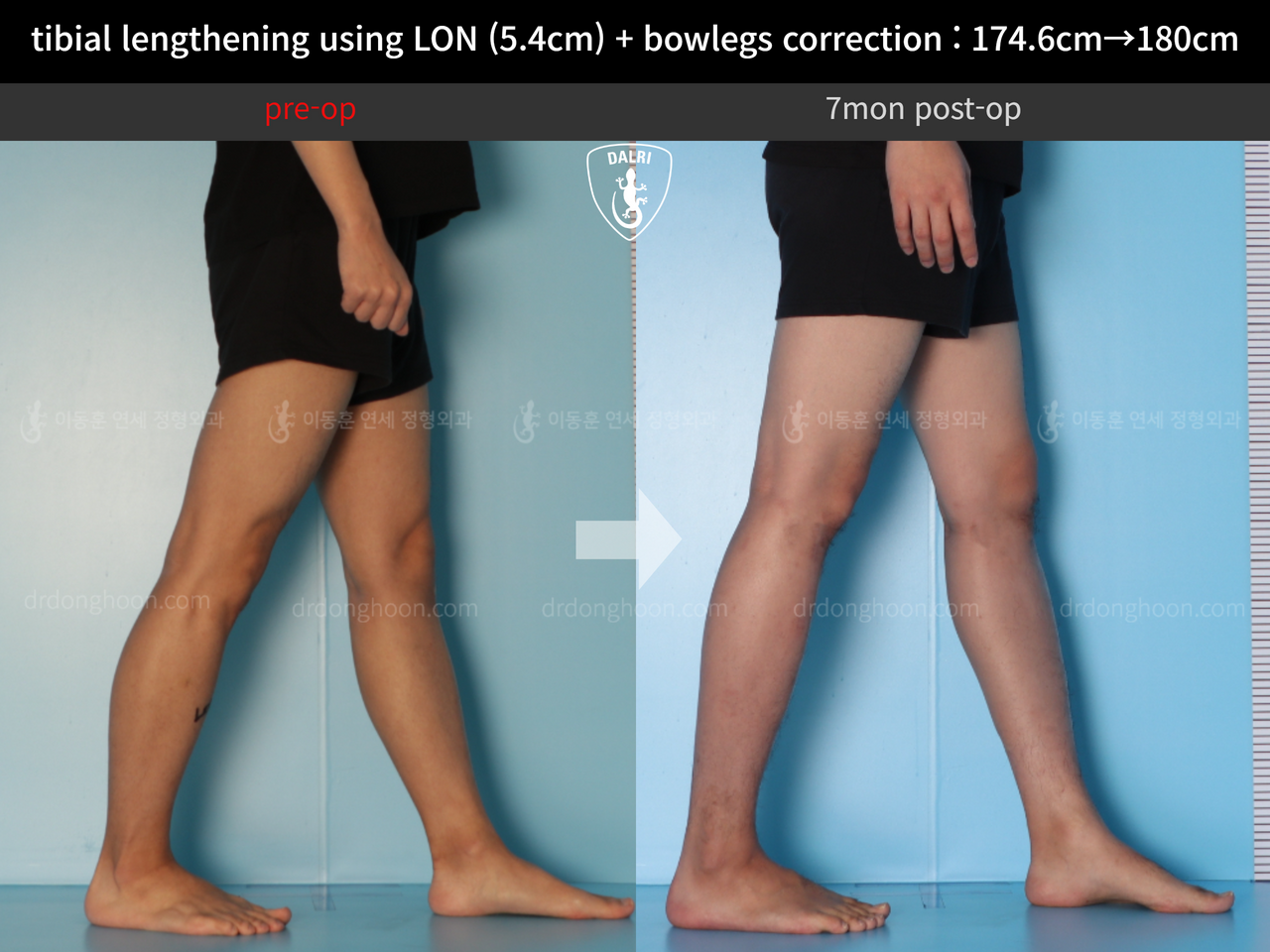 Before and after cll + deformity correction, case 12718558, image 9, Dr. Donghoon institute (DALRI)
