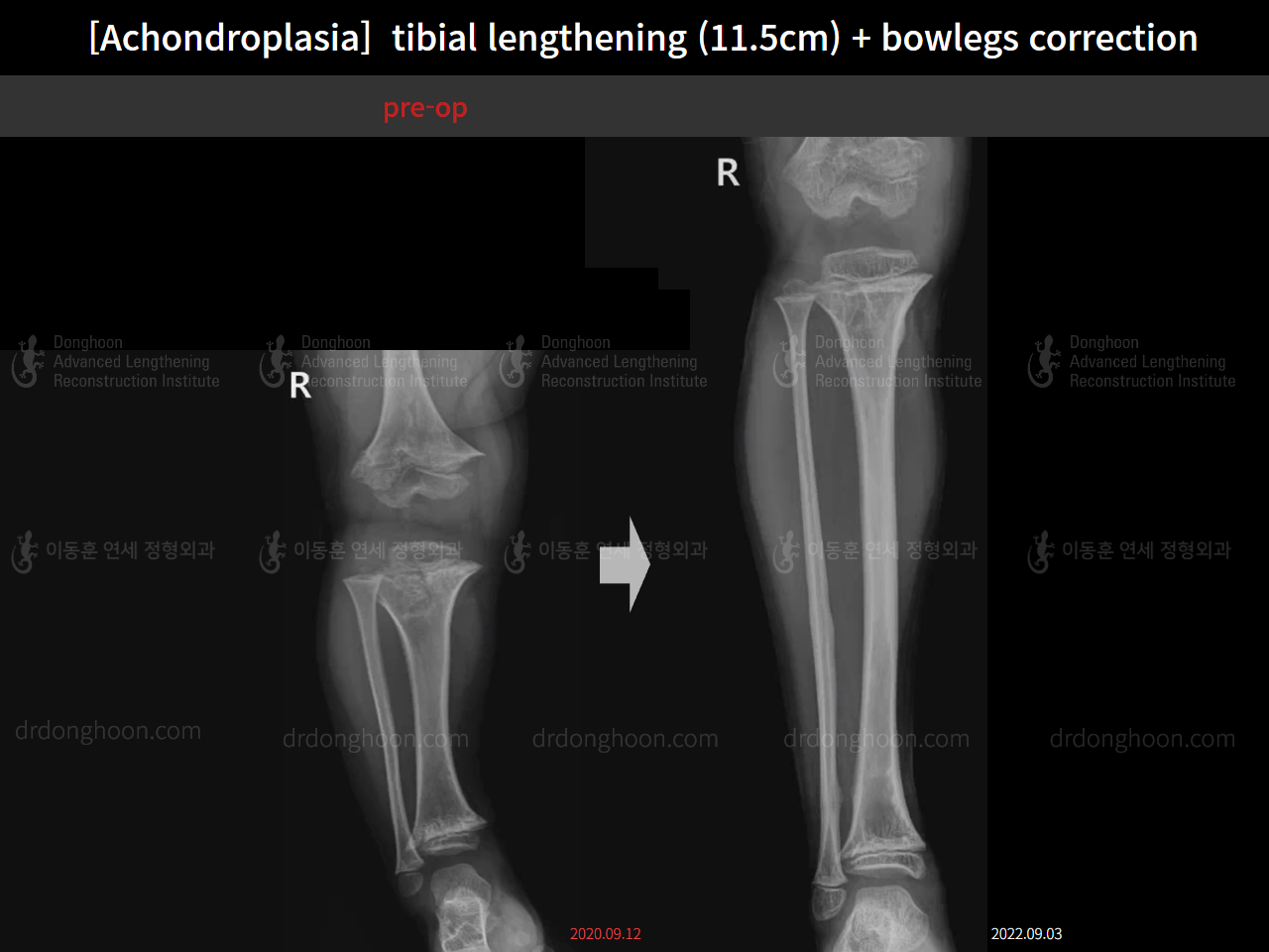 Before and after paediatric congenital condition, case 14957539, image 5, Dr. Donghoon institute (DALRI)