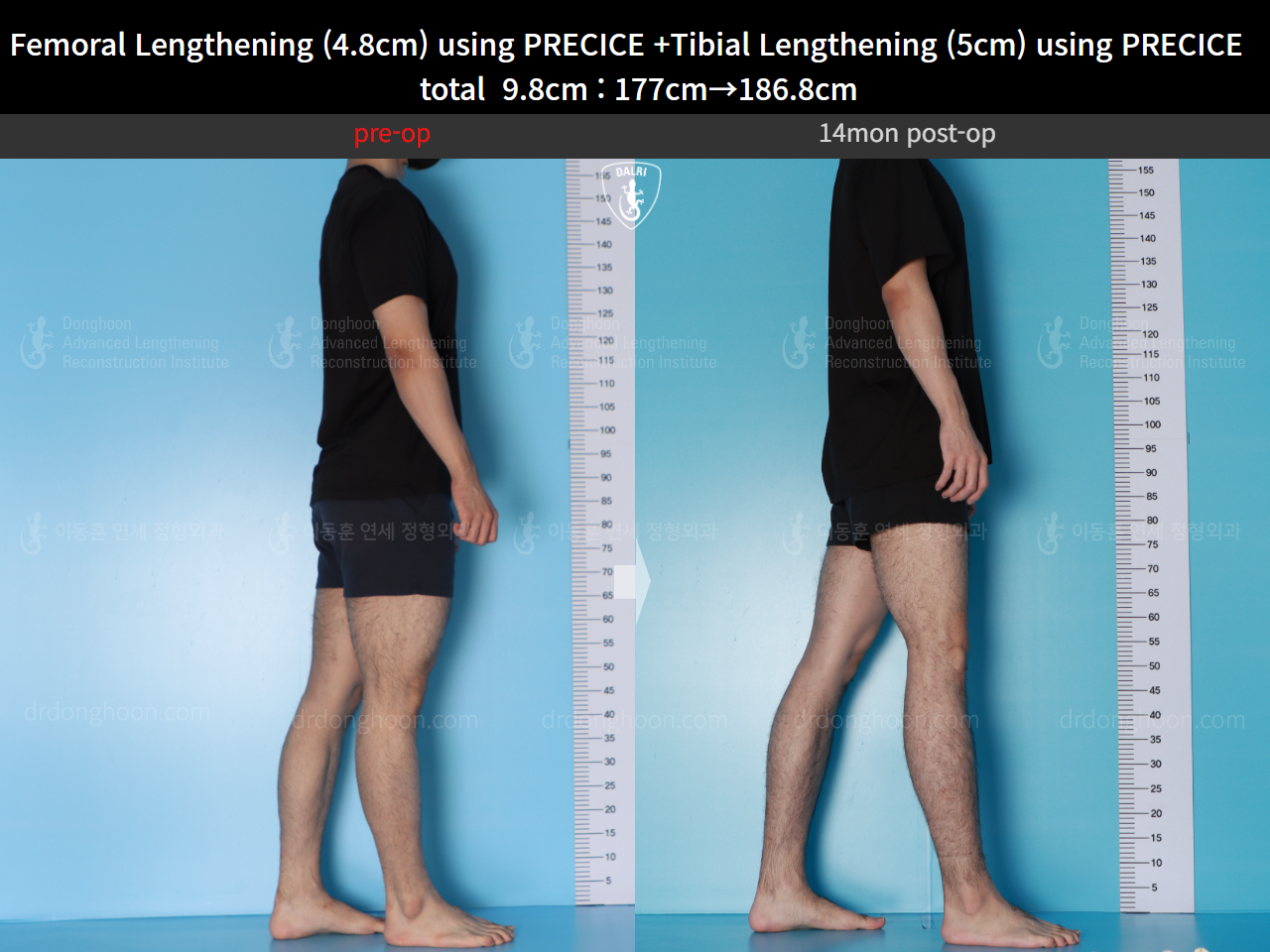 Before and after cll precice, case 16780196, image 3, Dr. Donghoon institute (DALRI)