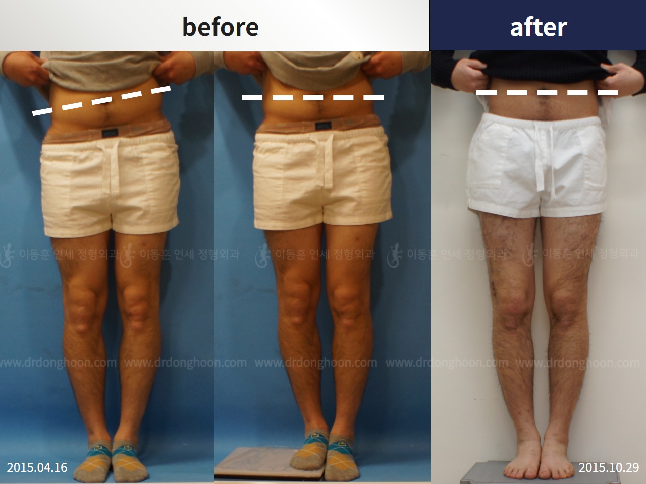 Before and after adult lld, case 4320319, image 2, Dr. Donghoon institute (DALRI)