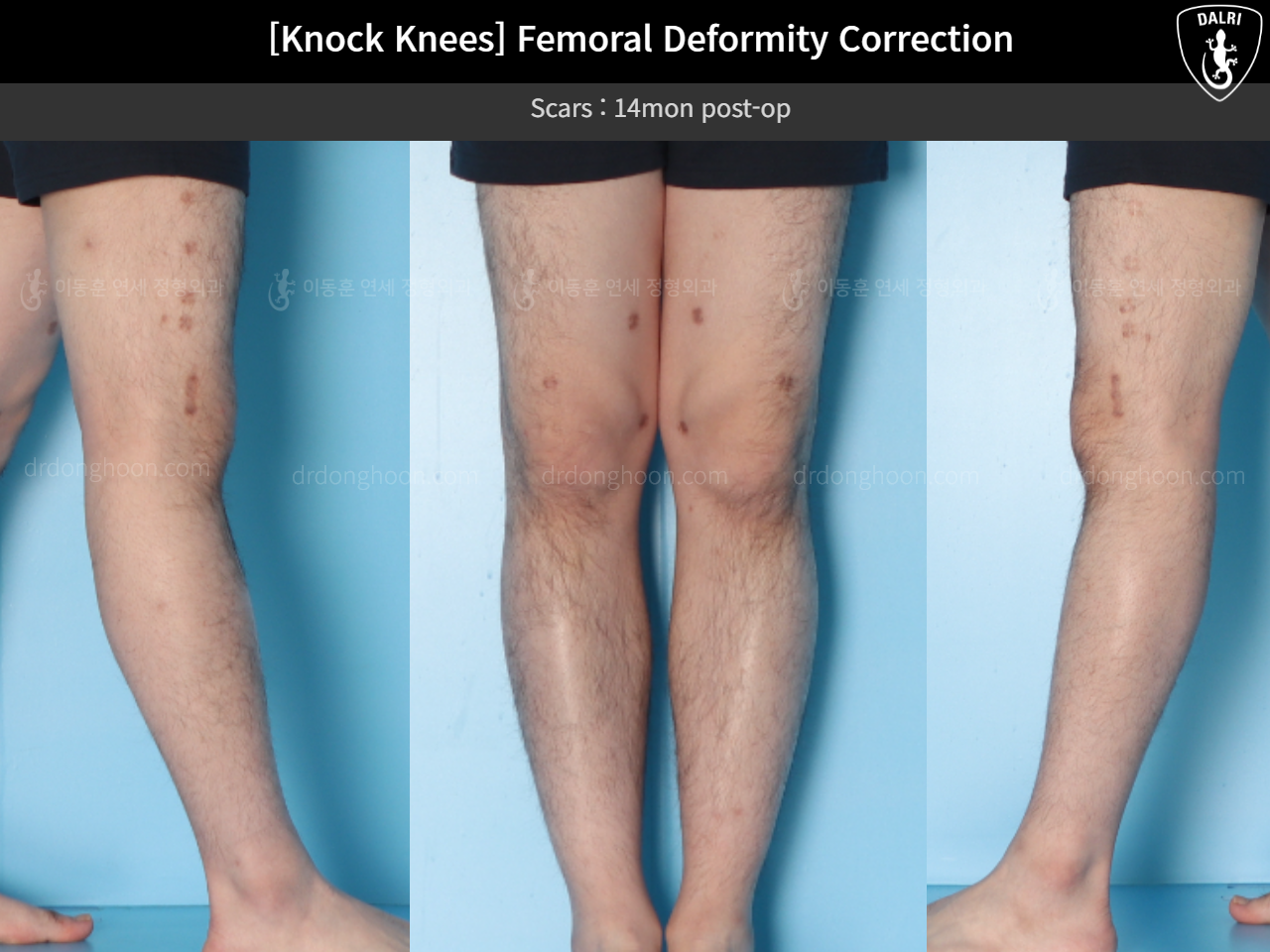 Before and after adult knock knees, case 15816319, image 9, Dr. Donghoon institute (DALRI)