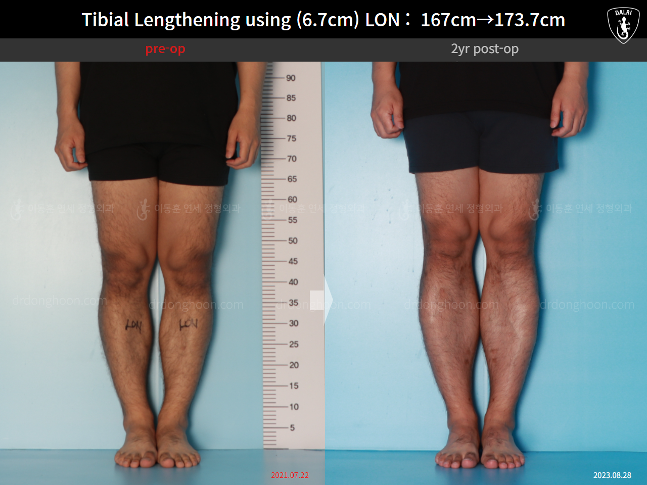 Before and after cll lon, case 16165376, image 7, Dr. Donghoon institute (DALRI)