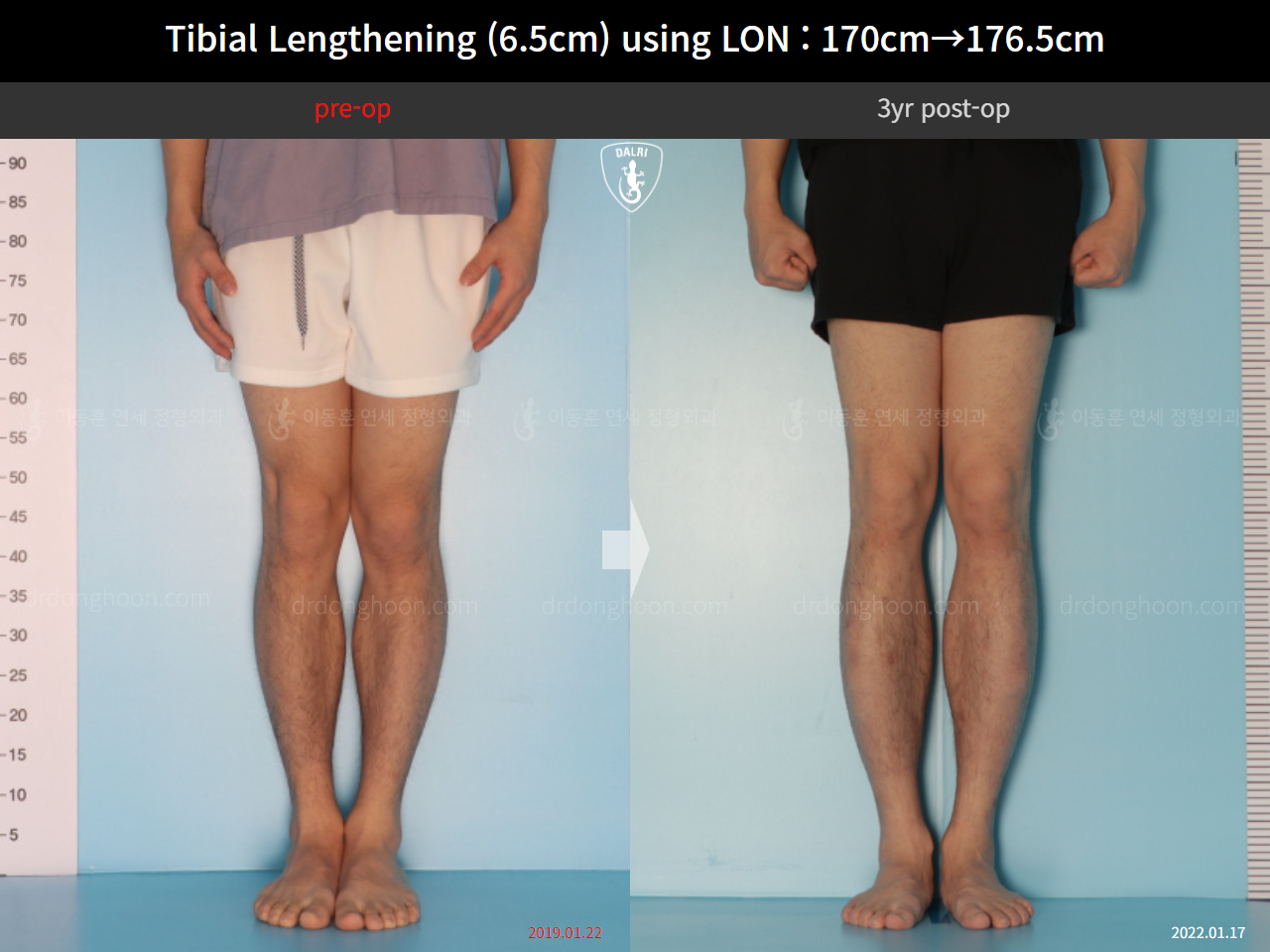 Before and after cll lon, case 16299082, image 5, Dr. Donghoon institute (DALRI)