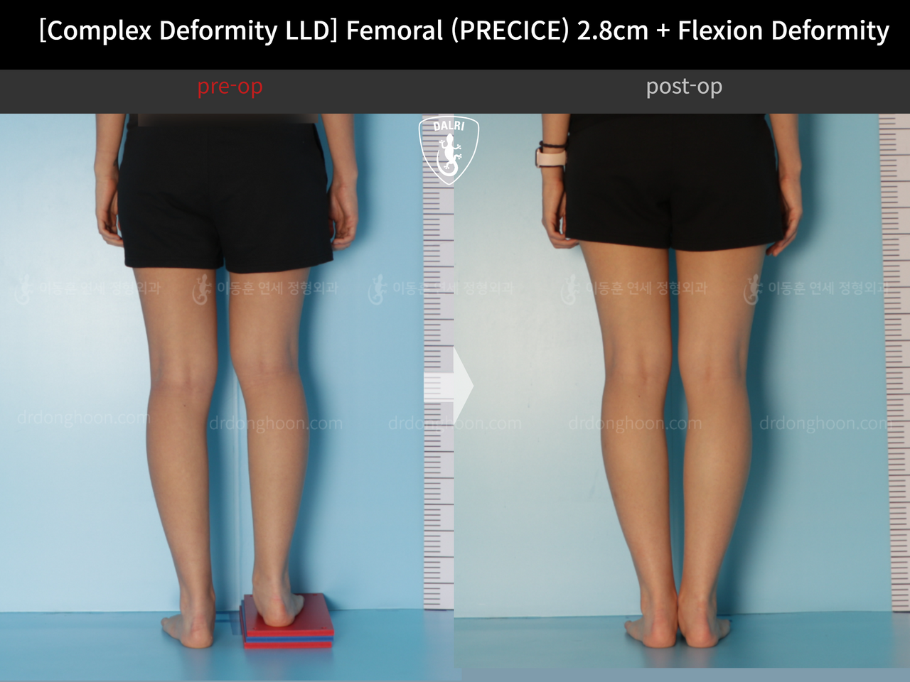 Before and after adult lld, case 13168213, image 5, Dr. Donghoon institute (DALRI)
