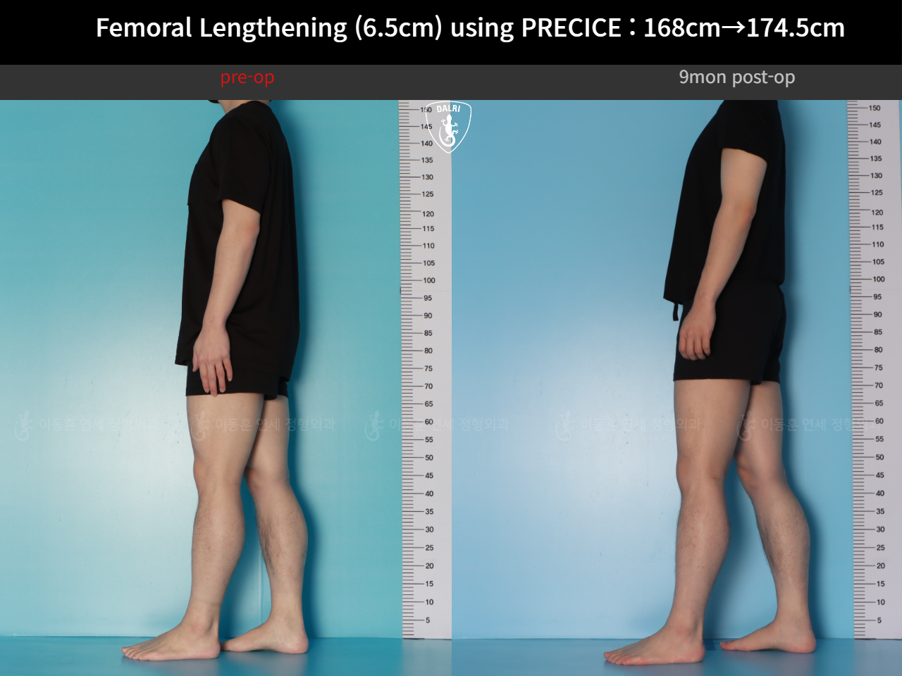 Before and after cll precice, case 123911358, image 3, Dr. Donghoon institute (DALRI)